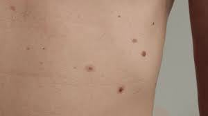 Mole Removal Without Scarring: Is It Possible?